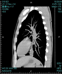 胸部ＣＴ縦隔条件（矢上断面）