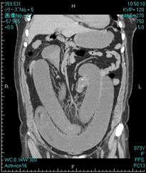 腹部ＣＴ（冠状断面）