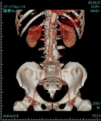 ３Ｄ－ＣＴ像