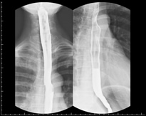上部食道・下部食道造影